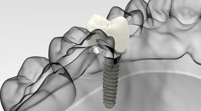 couronne sur implant