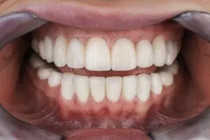 Implant basal