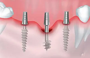 implant basal prix