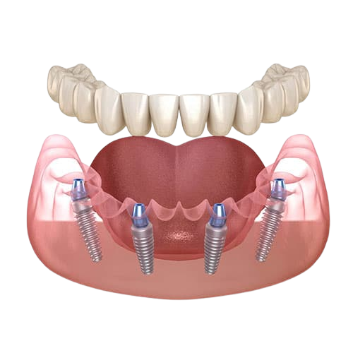 implant basal