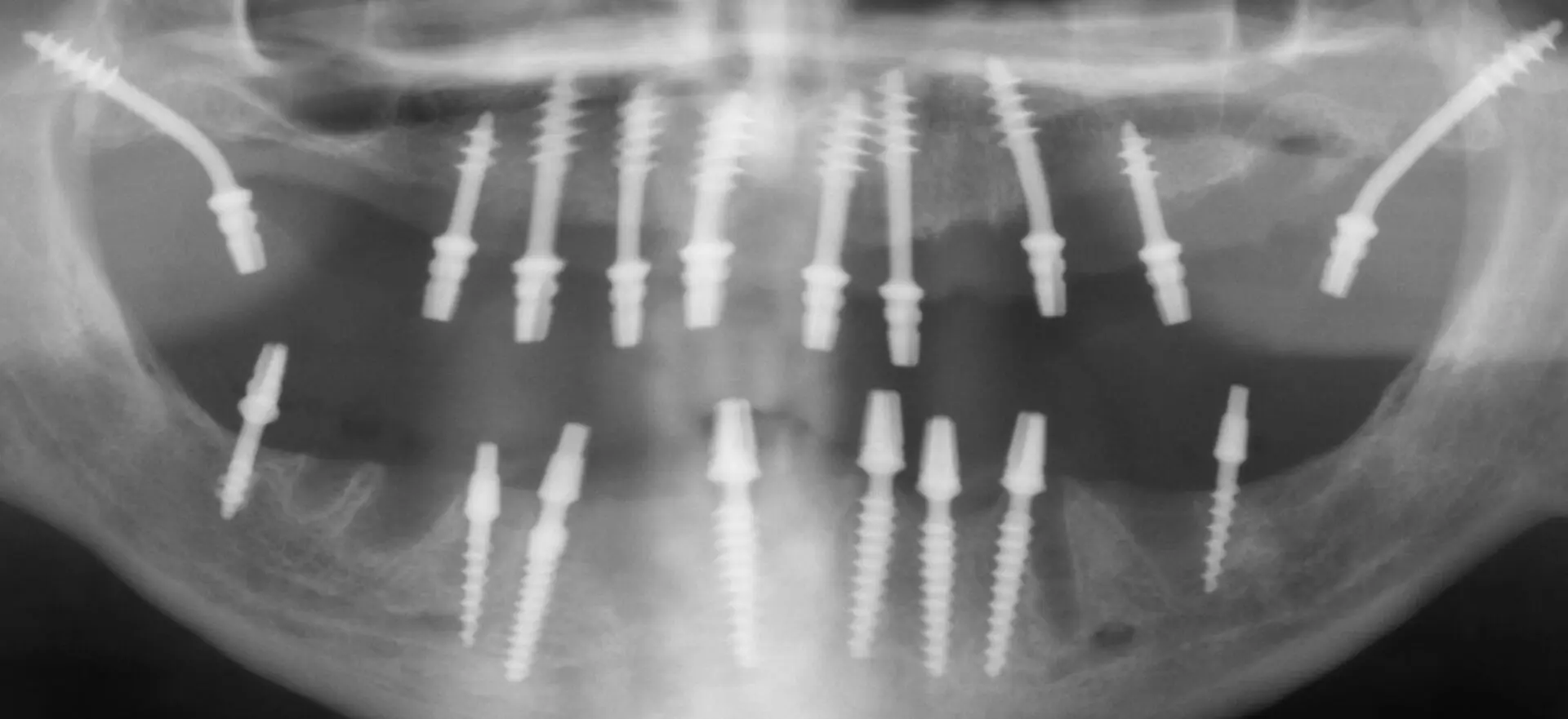 implant basal avis