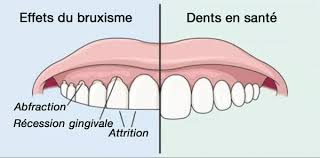 bruxisme