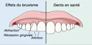 bruxisme