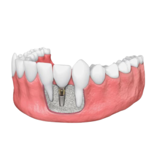 implant basal / Implant basaux