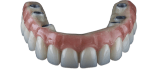 prothèse_dentaire_sur_implant