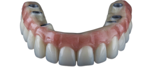 prothèse_dentaire_sur_implant