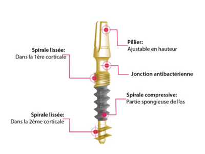 implant basal france