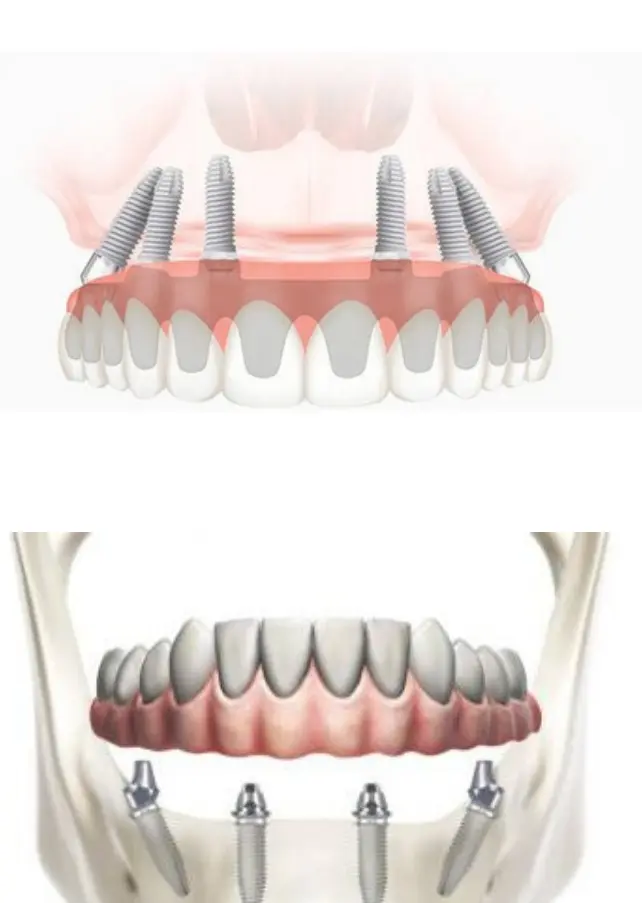 Dentier complet fixe All-on-4 All-on-6