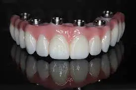 Dentier complet fixe