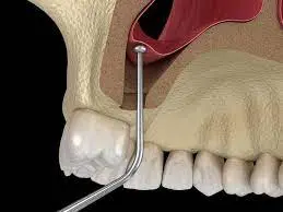 sinus-lift