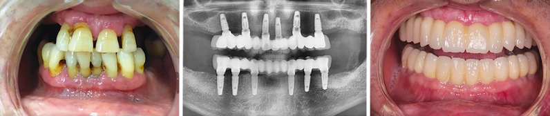 Implant dentaire allon6
