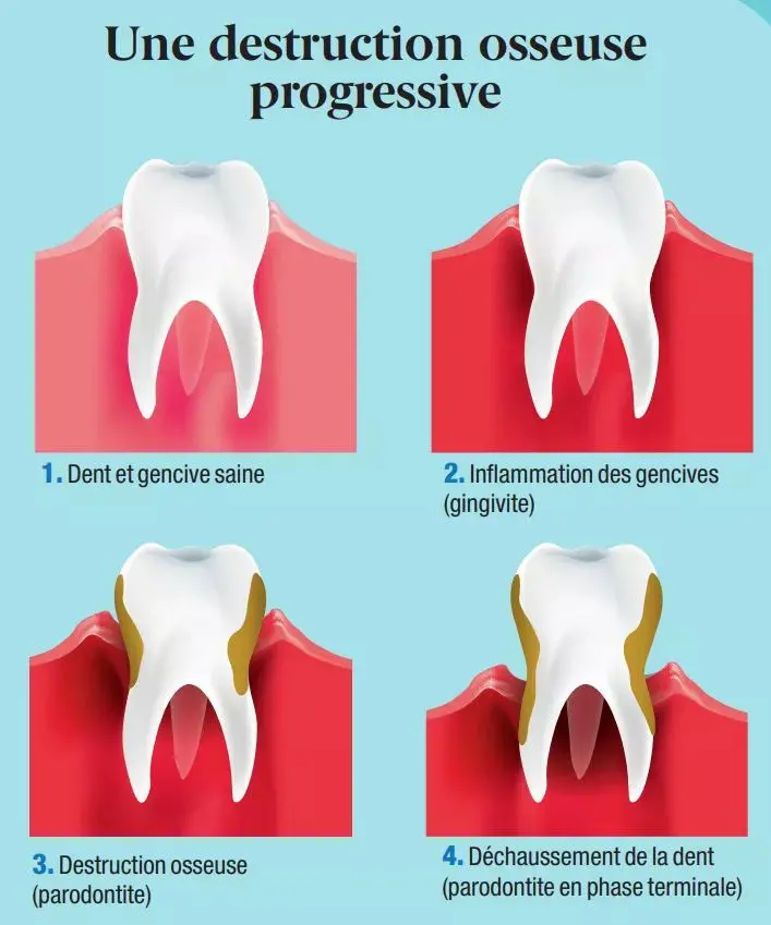 periodontitis
