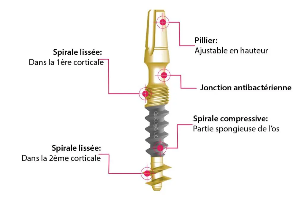 Implant basal prix