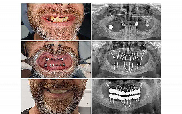 implant basal / Implants basaux