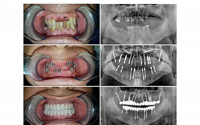Témoignage implant dentaire : Basal