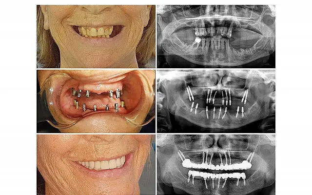 Témoignage implant dentaire : Basal