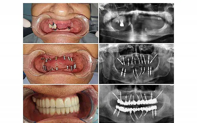 Témoignage implant dentaire : Basal