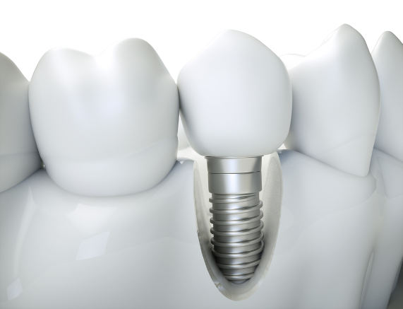 Pose implant dentaire