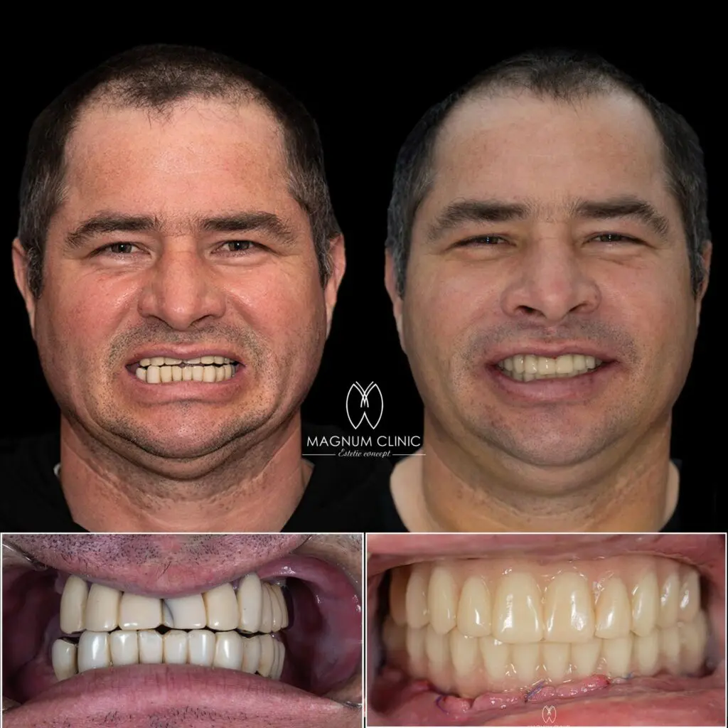 Témoignage implant dentaire : Traditionnel