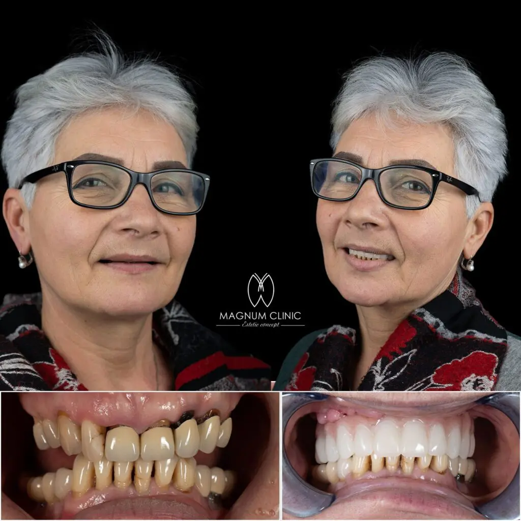 Témoignage implant dentaire : Traditionnel