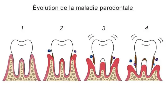 guérir parodontite
