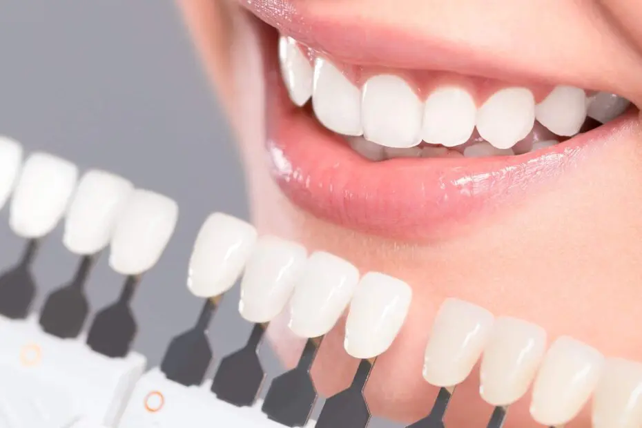 Faccetta dentale