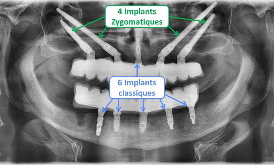 plantation dentaire zygoma