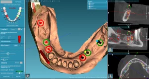 scanner 3D implant dentaire