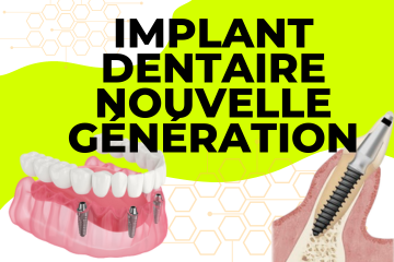 Implant Dentaire Nouvelle Génération