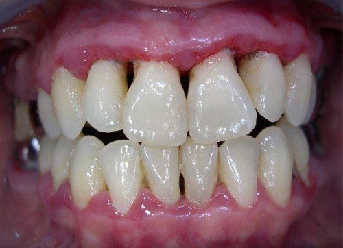 Parodontite Agressive Comprendre Et Traiter Sourire Dentaire