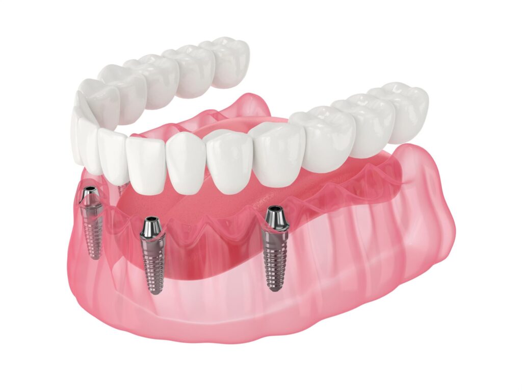 dentier sur implant