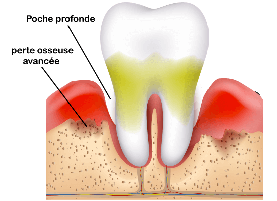 parodontie définition