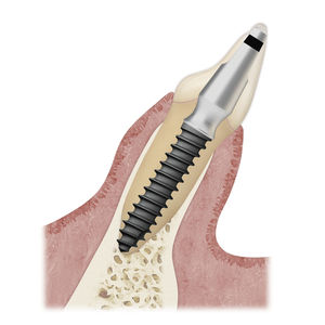 Implant dentaire immédiat