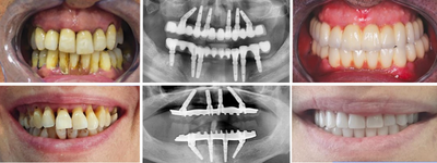 4-implant-dentaire-prix-2