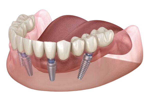 4 implant dentaire prix